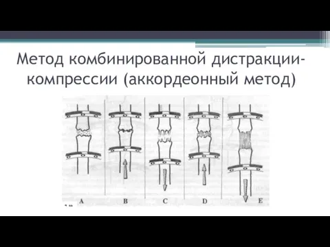 Метод комбинированной дистракции-компрессии (аккордеонный метод)