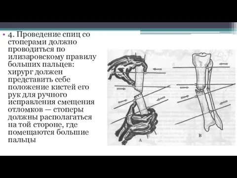 4. Проведение спиц со стоперами должно проводиться по илизаровскому правилу больших