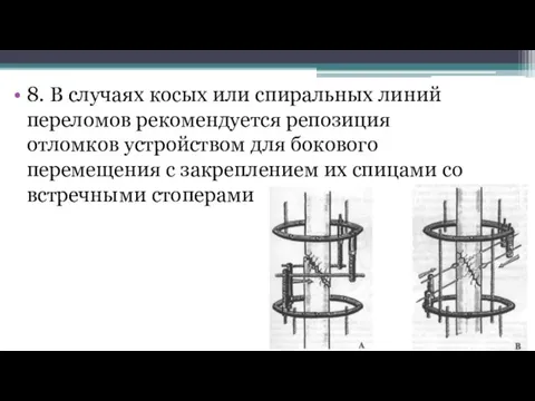 8. В случаях косых или спиральных линий переломов рекомендуется репозиция отломков