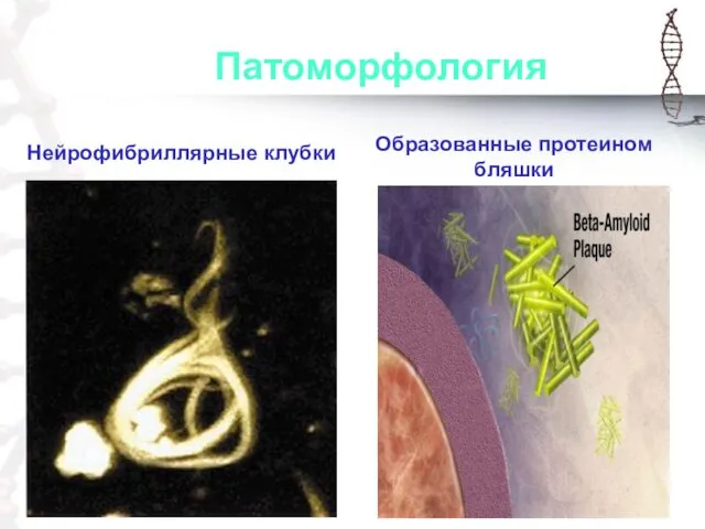 Патоморфология Нейрофибриллярные клубки Образованные протеином бляшки