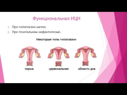 При гипоплазии матки; При генитальном инфантилизме. Функциональная ИЦН