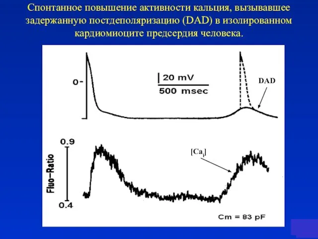 #3 Спонтанное повышение активности кальция, вызывавшее задержанную постдеполяризацию (DAD) в изолированном кардиомиоците предсердия человека.