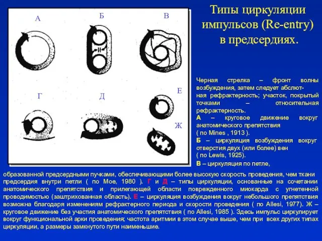 Б В Г Д Е Ж Типы циркуляции импульсов (Re-entry) в