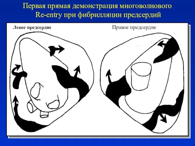 Первая прямая демонстрация многоволнового Re-entry при фибрилляции предсердий Левое предсердие Правое предсердие