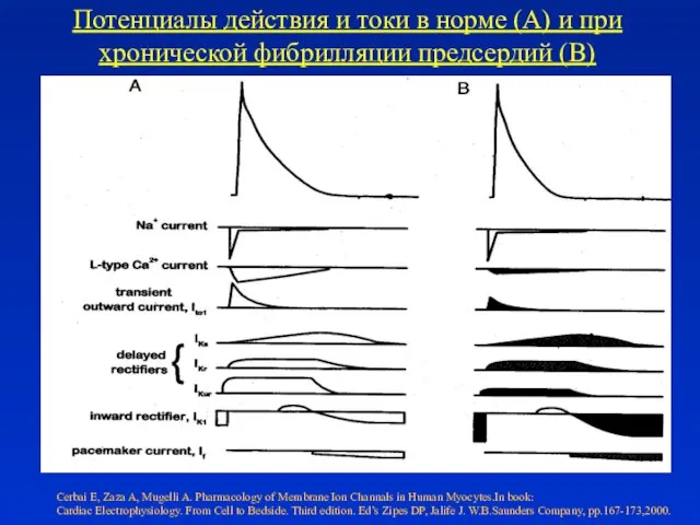 Потенциалы действия и токи в норме (А) и при хронической фибрилляции