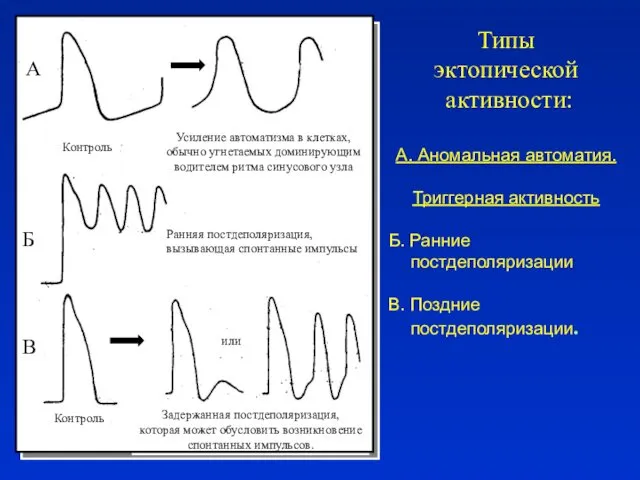 Типы эктопической активности: А. Аномальная автоматия. Триггерная активность Б. Ранние постдеполяризации В. Поздние постдеполяризации.