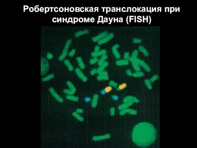 Робертсоновская транслокация при синдроме Дауна (FISH)