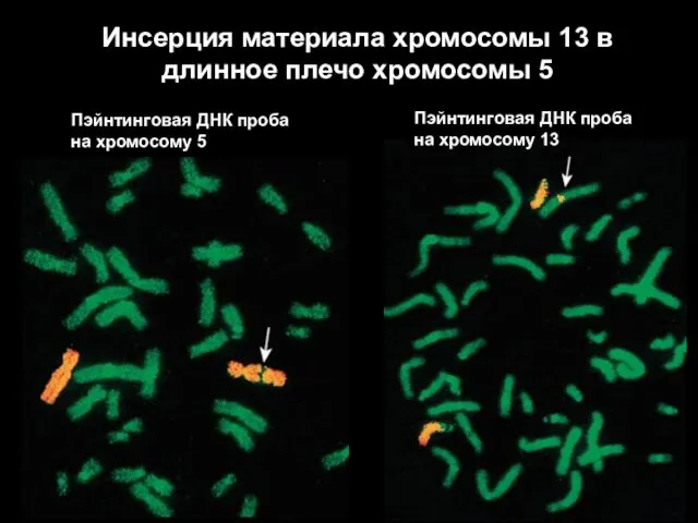 Инсерция материала хромосомы 13 в длинное плечо хромосомы 5 Пэйнтинговая ДНК