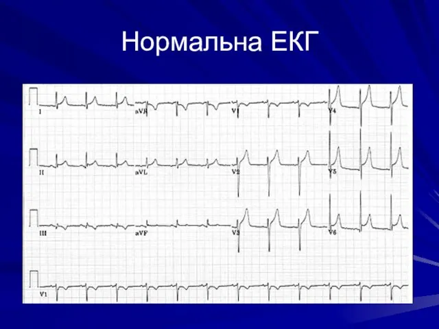 Нормальна ЕКГ