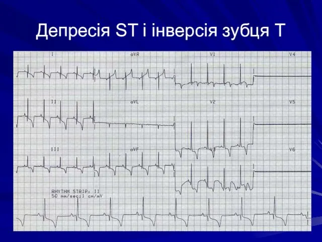 Депресія ST і інверсія зубця T