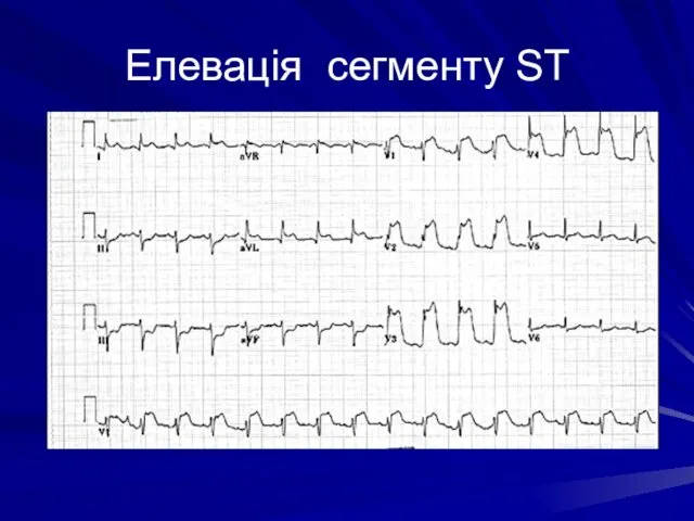 Елевація сегменту ST