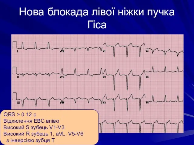 Нова блокада лівої ніжки пучка Гіса QRS > 0.12 с Відхилення