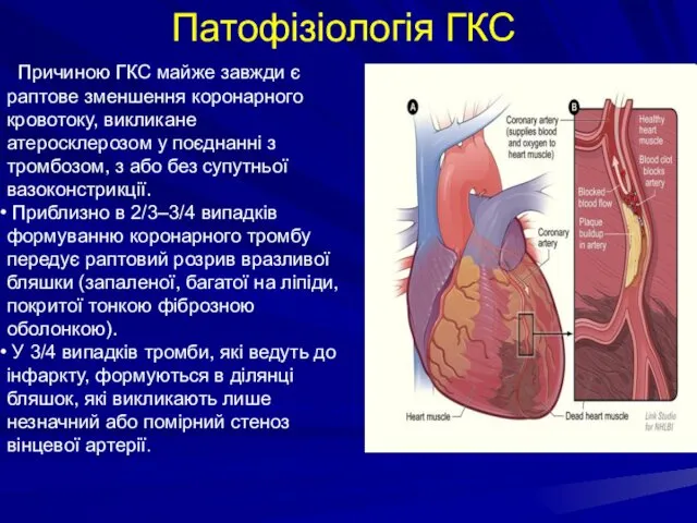 Причиною ГКС майже завжди є раптове зменшення коронарного кровотоку, викликане атеросклерозом
