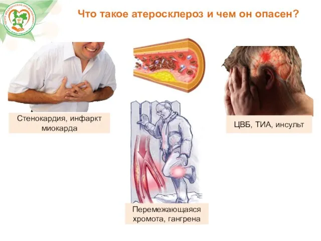 Что такое атеросклероз и чем он опасен? ЦВБ, ТИА, инсульт Перемежающаяся хромота, гангрена Стенокардия, инфаркт миокарда