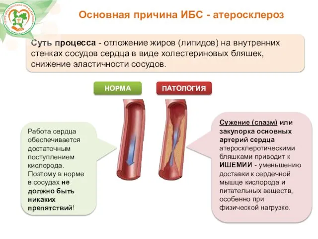 Основная причина ИБС - атеросклероз Суть процесса - отложение жиров (липидов)