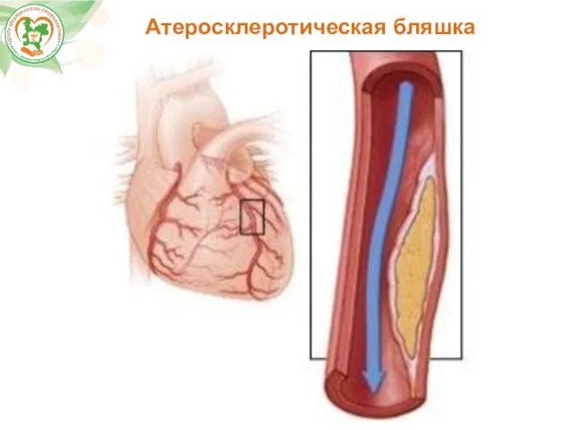 Атеросклеротическая бляшка