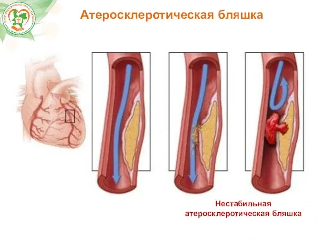 Атеросклеротическая бляшка Нестабильная атеросклеротическая бляшка