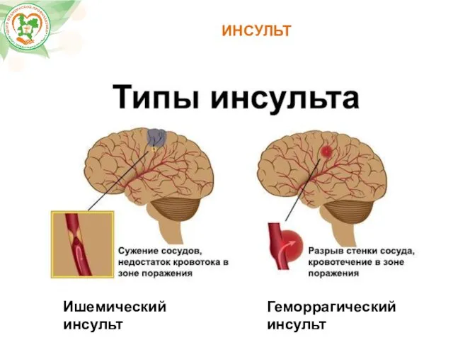 ИНСУЛЬТ Ишемический инсульт Геморрагический инсульт