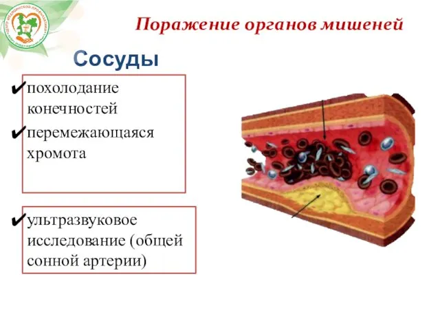 Поражение органов мишеней Сосуды похолодание конечностей перемежающаяся хромота ультразвуковое исследование (общей сонной артерии)