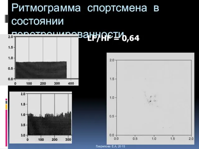 Ритмограмма спортсмена в состоянии перетренированности Гаврилова Е.А. 2015 LF/HF = 0,64