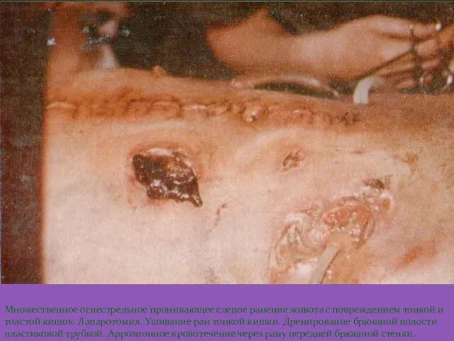 Множественное огнестрельное проникающее слепое ранение живота с повреждением тонкой и толстой