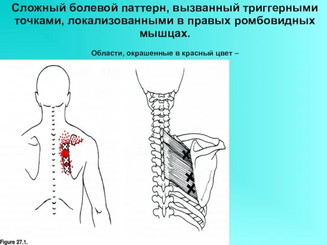 Сложный болевой паттерн, вызванный триггерными точками, локализованными в правых ромбовидных мышцах.