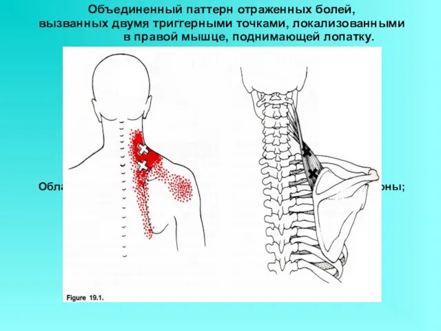 Объединенный паттерн отраженных болей, вызванных двумя триггерными точками, локализованными в правой