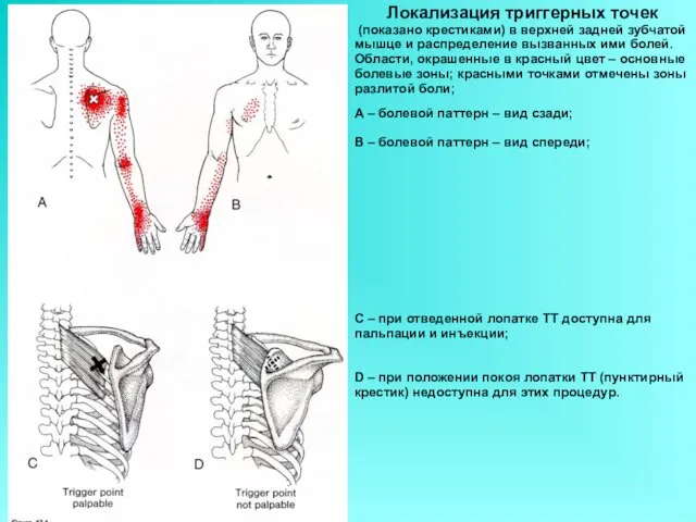 Локализация триггерных точек (показано крестиками) в верхней задней зубчатой мышце и