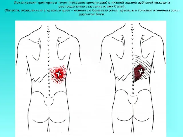 Локализация триггерных точек (показано крестиками) в нижней задней зубчатой мышце и