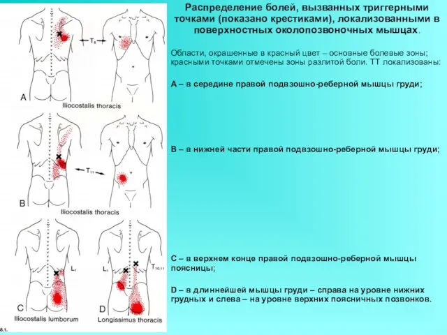 Распределение болей, вызванных триггерными точками (показано крестиками), локализованными в поверхностных околопозвоночных