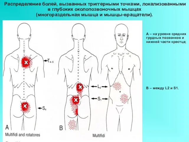 Распределение болей, вызванных триггерными точками, локализованными в глубоких околопозвоночных мышцах (многораздельная