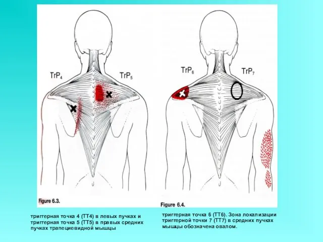 триггерная точка 4 (ТТ4) в левых пучках и триггерная точка 5