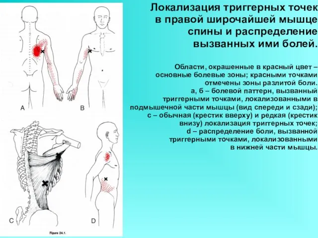 Локализация триггерных точек в правой широчайшей мышце спины и распределение вызванных