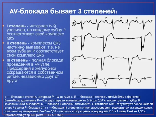 AV-блокада бывает 3 степеней: I степень - интервал P-Q увеличен, но