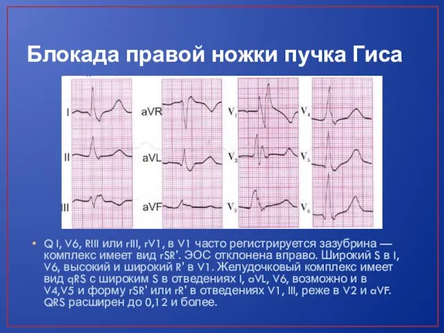 Блокада правой ножки пучка Гиса Q I, V6, RIII или rIII,