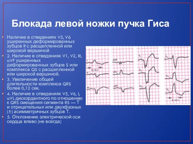 Блокада левой ножки пучка Гиса Наличие в отведениях V5, V6 уширенных