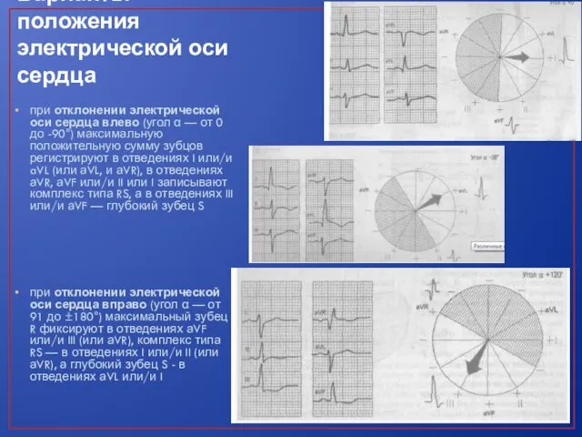 Варианты положения электрической оси сердца при отклонении электрической оси сердца влево