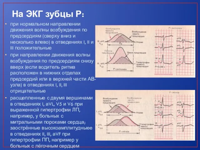 На ЭКГ зубцы Р: при нормальном направлении движения волны возбуждения по