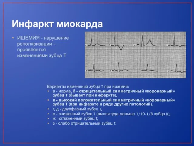 Инфаркт миокарда ИШЕМИЯ - нарушение реполяризации -проявляется изменениями зубца T Варианты