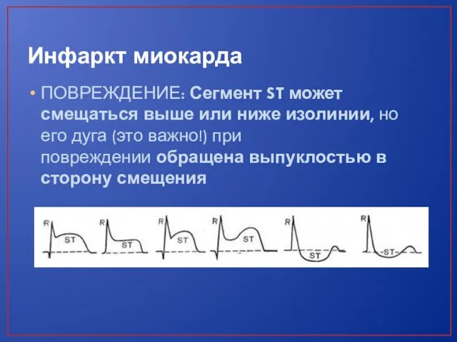 Инфаркт миокарда ПОВРЕЖДЕНИЕ: Сегмент ST может смещаться выше или ниже изолинии,