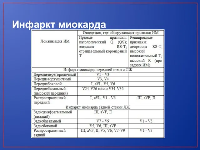 Инфаркт миокарда