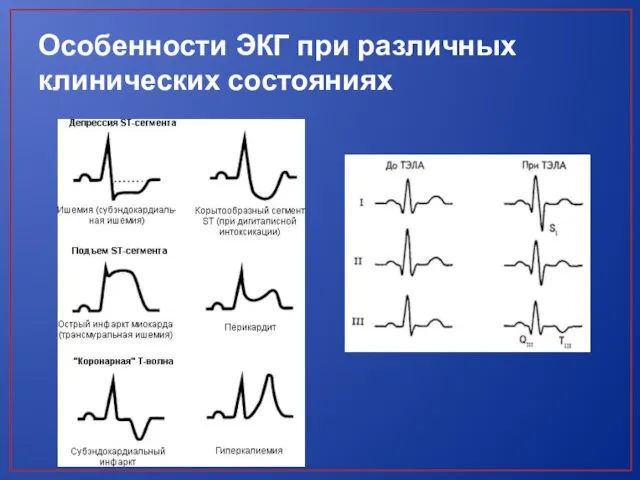 Особенности ЭКГ при различных клинических состояниях