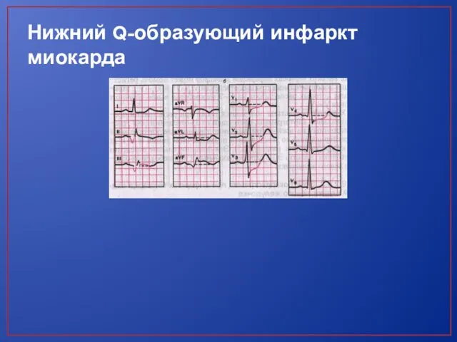 Нижний Q-образующий инфаркт миокарда