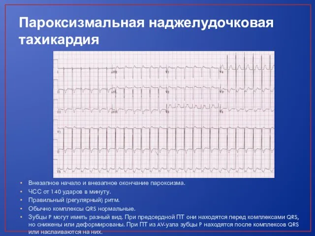 Пароксизмальная наджелудочковая тахикардия Внезапное начало и внезапное окончание пароксизма. ЧСС от