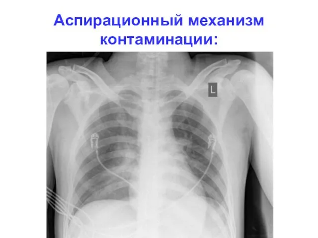 Аспирационный механизм контаминации: