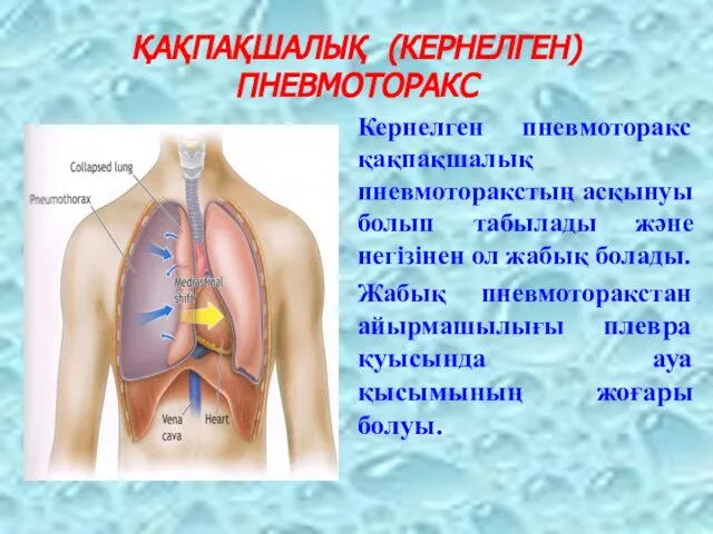 ҚАҚПАҚШАЛЫҚ (КЕРНЕЛГЕН) ПНЕВМОТОРАКС Кернелген пневмоторакс қақпақшалық пневмоторакстың асқынуы болып табылады және