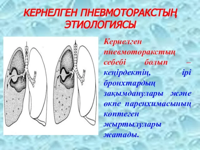 КЕРНЕЛГЕН ПНЕВМОТОРАКСТЫҢ ЭТИОЛОГИЯСЫ Кернелген пневмоторакстың себебі болып – кеңірдектің, ірі бронхтардың