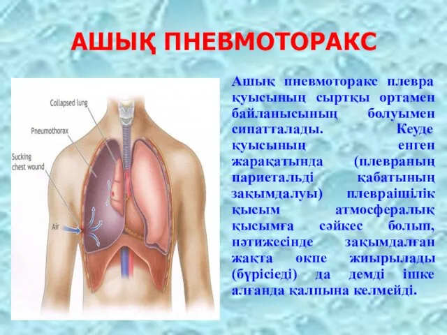 АШЫҚ ПНЕВМОТОРАКС Ашық пневмоторакс плевра қуысының сыртқы ортамен байланысының болуымен сипатталады.