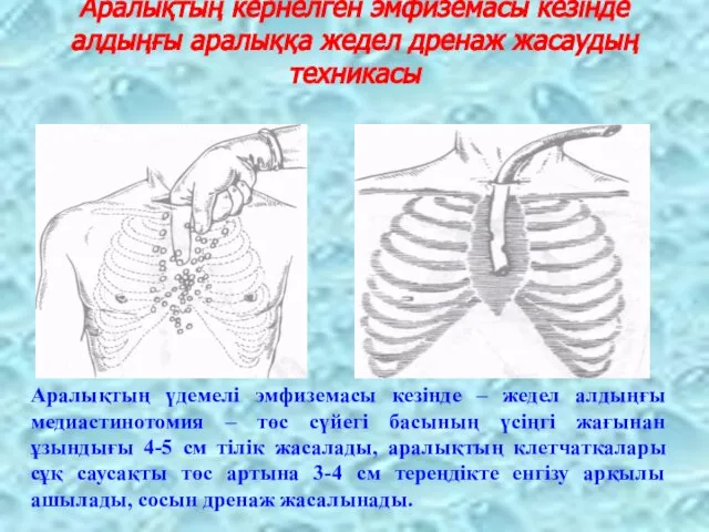 Аралықтың кернелген эмфиземасы кезінде алдыңғы аралыққа жедел дренаж жасаудың техникасы Аралықтың