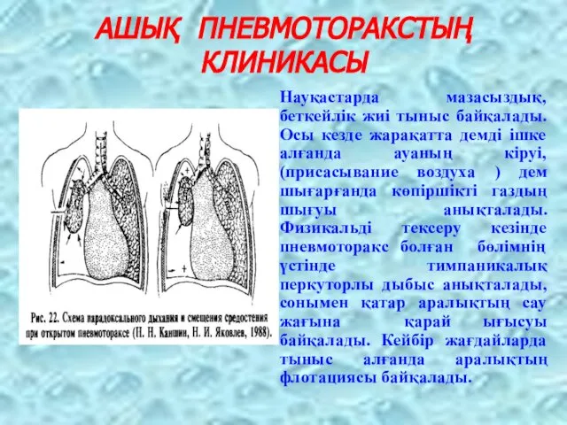 АШЫҚ ПНЕВМОТОРАКСТЫҢ КЛИНИКАСЫ Науқастарда мазасыздық, беткейлік жиі тыныс байқалады. Осы кезде